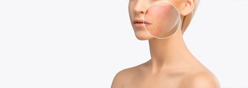trattamento integrato acne