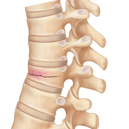la frattura di una vertebra può causare dolore nella parte alta della schiena quando si respira
