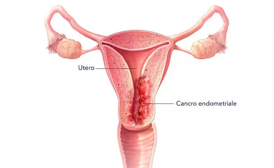 cancro endometriale
