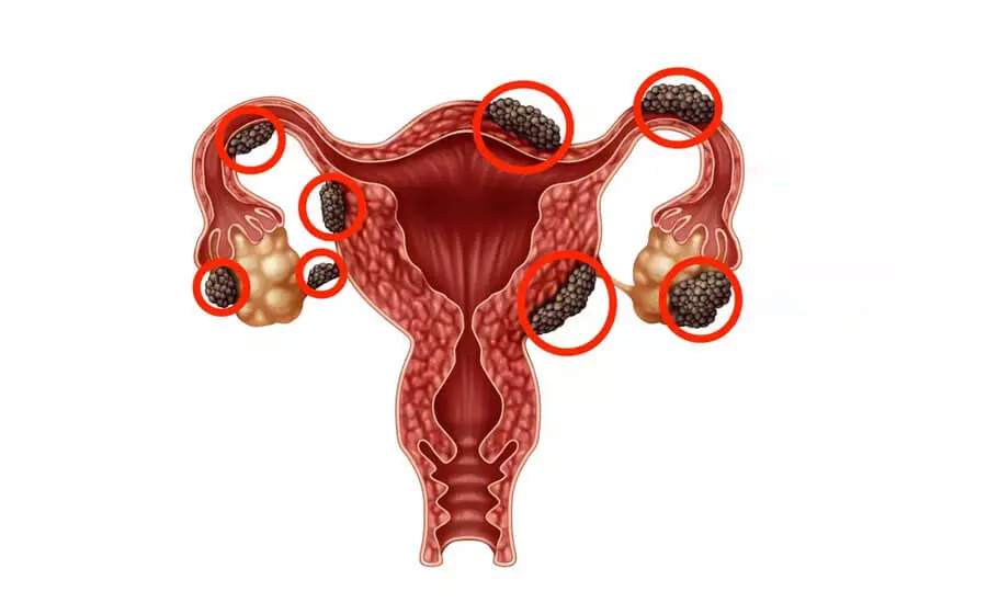 endometriosi e ciclo irregolare