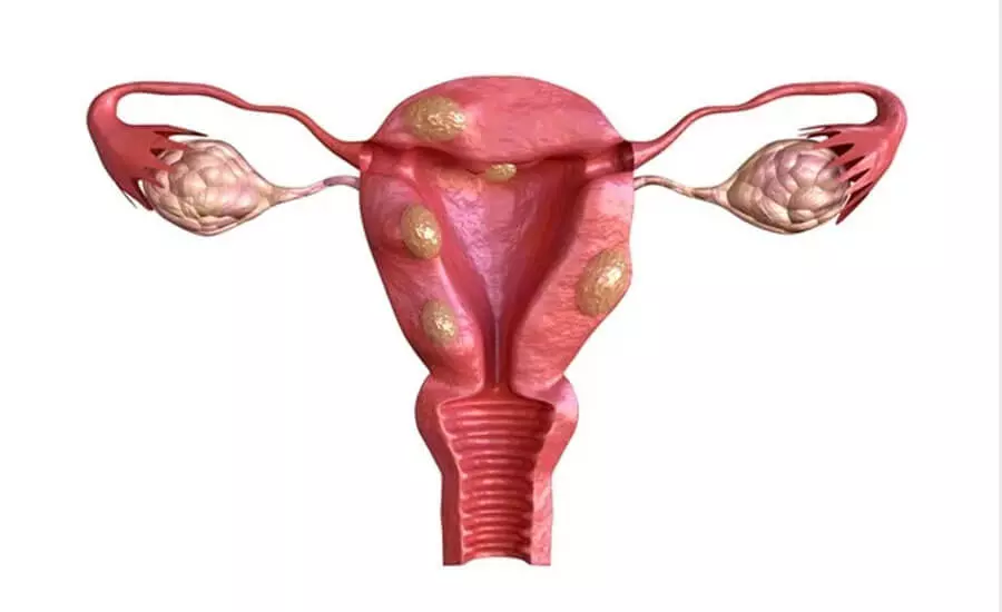 fibromi uterini e problemi mestruali