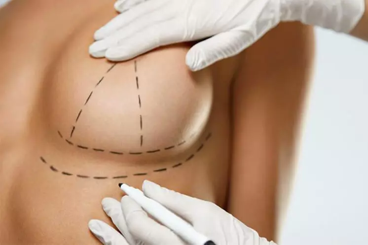 lifting del seno - mastopessi - chirurgia estetica