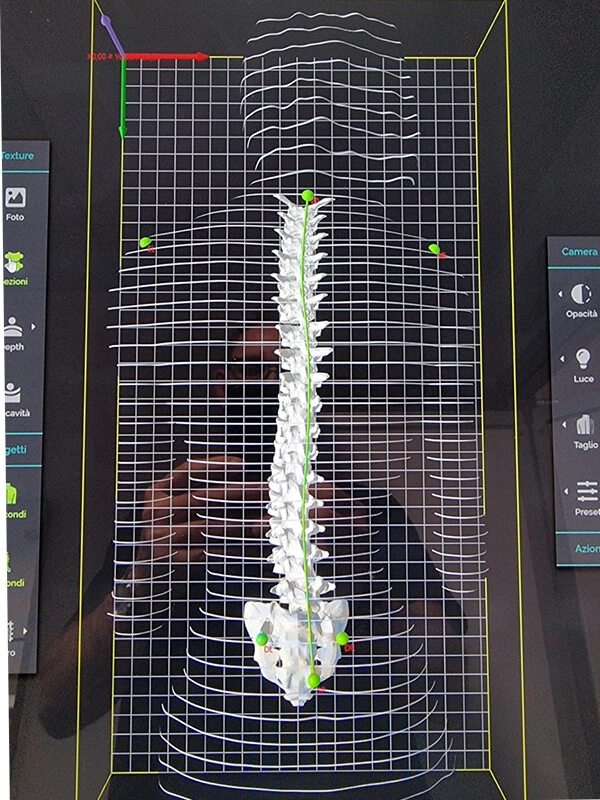 Colonna vertebrale di un paziente prima di iniziare il Percorso Plantari al Biomedic Clinic & Research