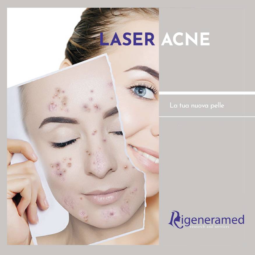 trattamento laser dell'acne